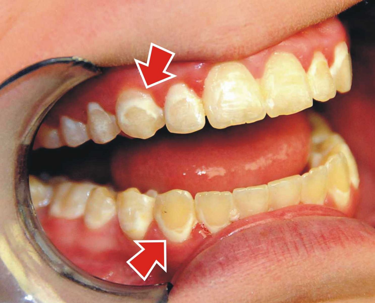 braces ceramic metal much teeth better than gums faster results invisalign comes effective