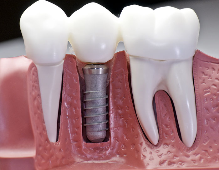 Dental Implants texas