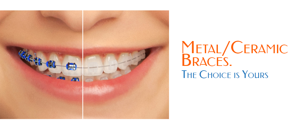 aesthetic and conventionally pleasing braces in angleton tx